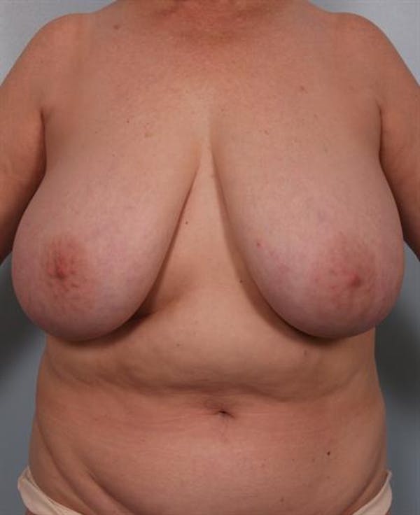 Power Assisted Liposuction Before & After Gallery - Patient 1311117 - Image 1