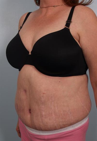 Tummy Tuck Gallery - Patient 1311116 - Image 6