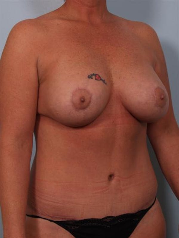 Power Assisted Liposuction Before & After Gallery - Patient 1311120 - Image 4