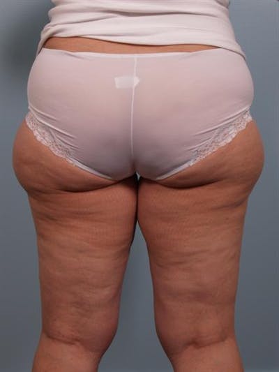 Power Assisted Liposuction Before & After Gallery - Patient 1311121 - Image 1