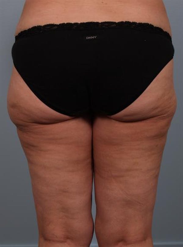 Power Assisted Liposuction Before & After Gallery - Patient 1311121 - Image 2