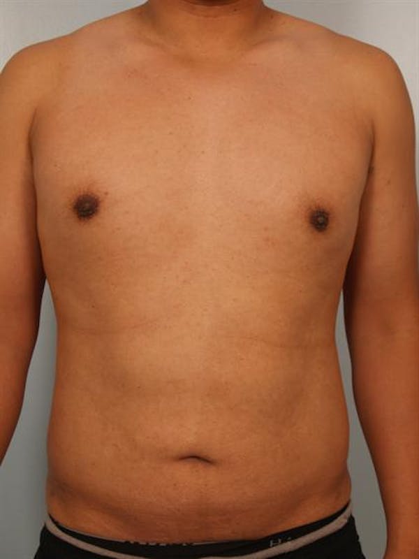 Power Assisted Liposuction Before & After Gallery - Patient 1311122 - Image 4
