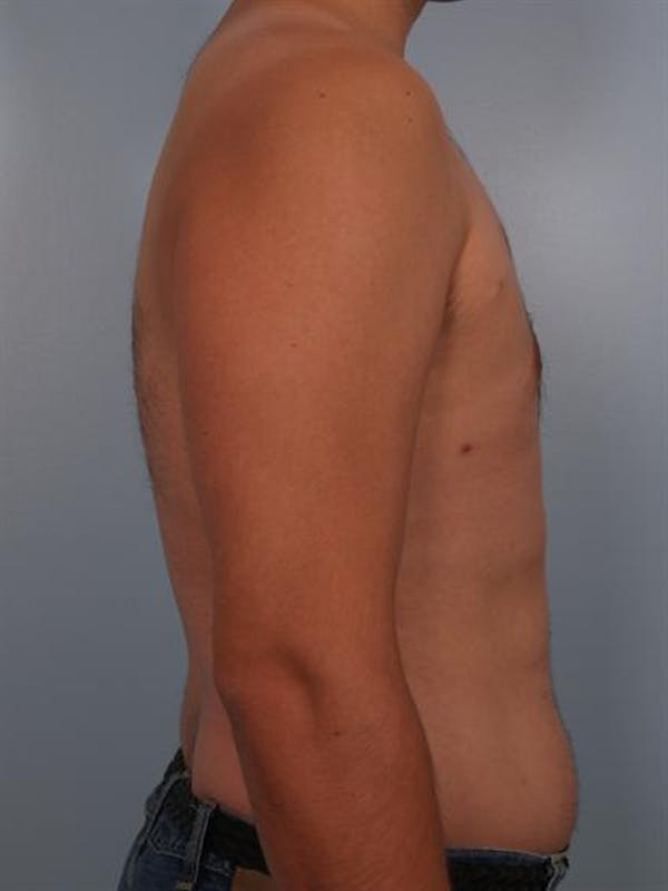 Power Assisted Liposuction Before & After Gallery - Patient 1311124 - Image 2