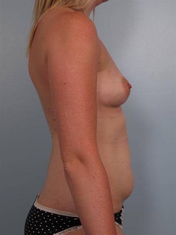 Power Assisted Liposuction Before & After Gallery - Patient 1311126 - Image 3