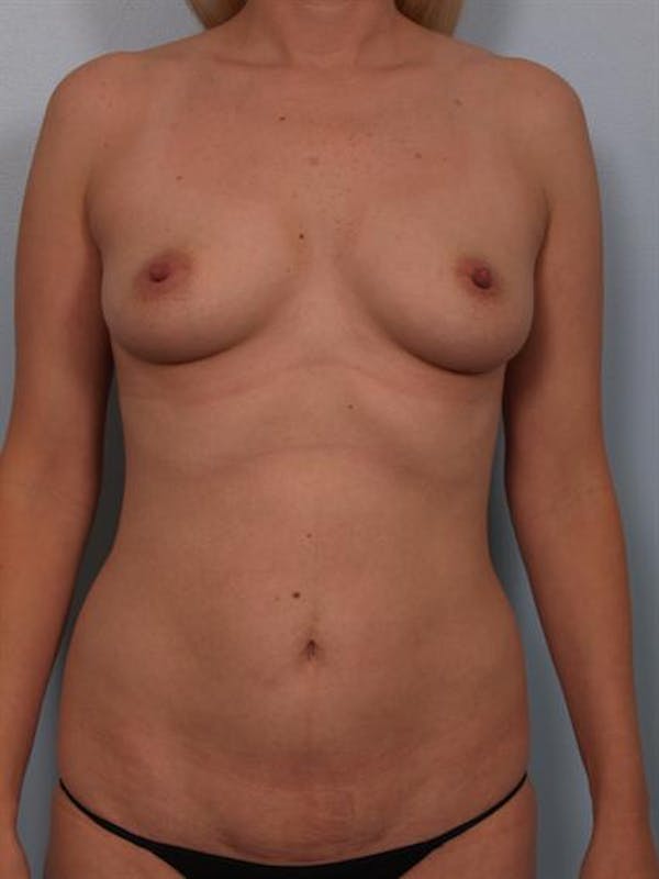 Power Assisted Liposuction Gallery - Patient 1311127 - Image 3