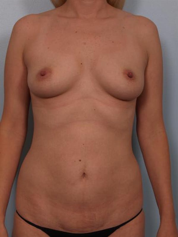 Power Assisted Liposuction Before & After Gallery - Patient 1311127 - Image 3