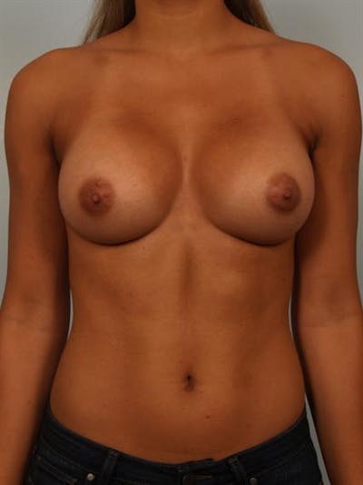 Power Assisted Liposuction Before & After Gallery - Patient 1311128 - Image 2