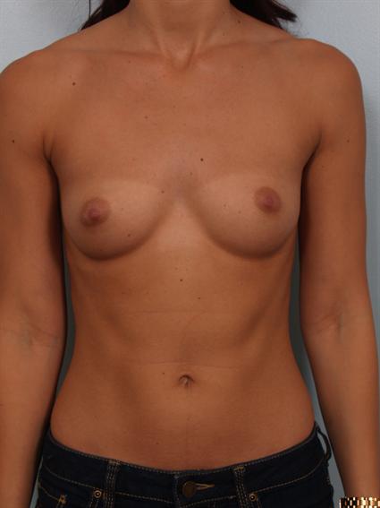 Straight on before photo of breast augmentation - 1