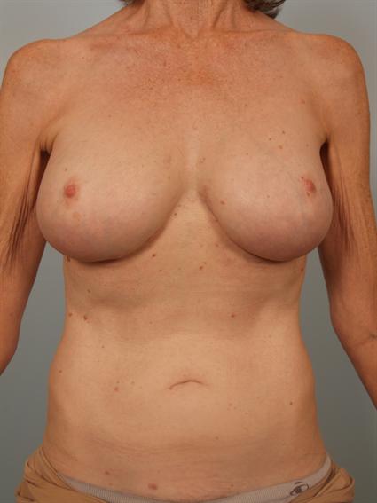 Straight on after photo of breast implant revision