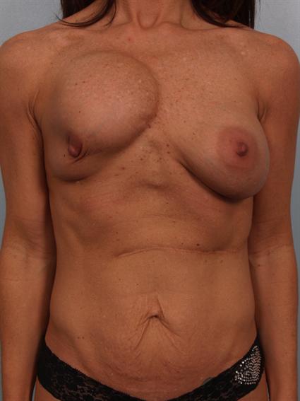 Straight on before photo of Breast Implant Revision/Breast Lift/Tummy Tuck