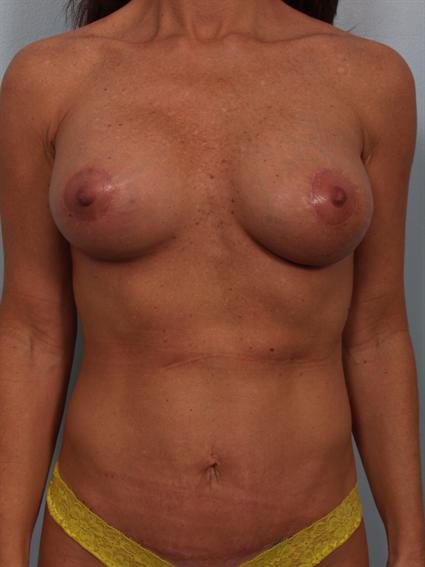 Straight on after photo of Breast Implant Revision/Breast Lift/Tummy Tuck