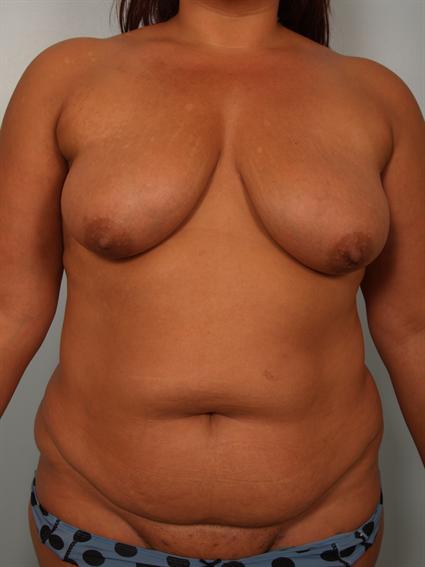 Straight on before photo of Breast Lift/Fat Grafting/Mommy Makeover