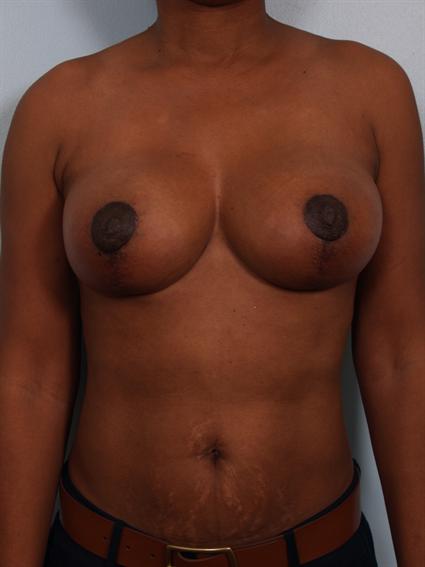 Straight on after photo of Breast Reduction/Breast Lift