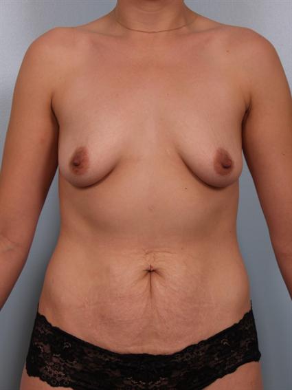 Straight on before photo of Breast Augmentation/Breast Lift/Mommy Makeover