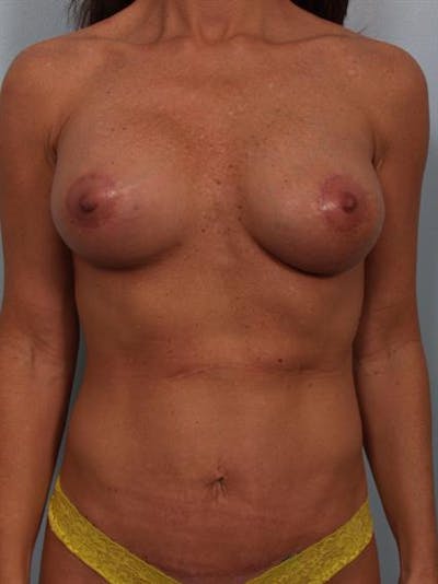 Breast Lift with Implants Before & After Gallery - Patient 1612632 - Image 2