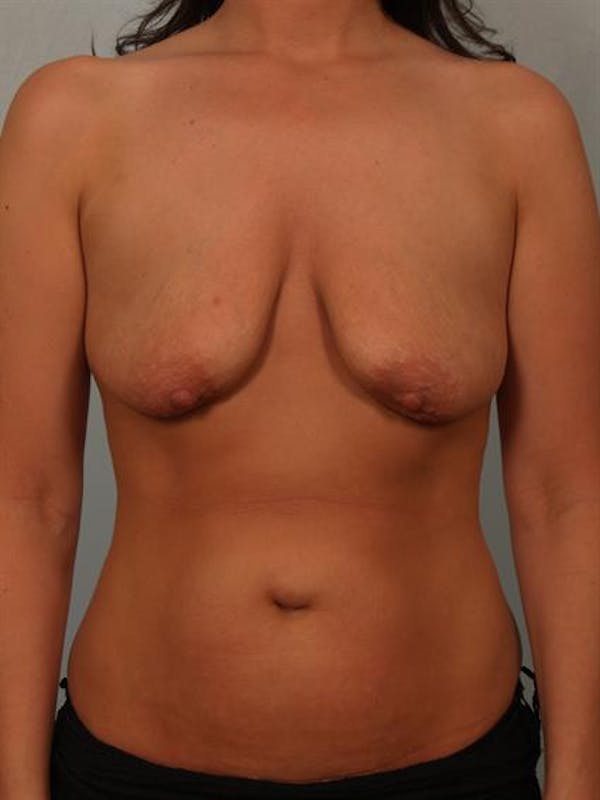 Breast Lift with Implants Before & After Gallery - Patient 1612637 - Image 3