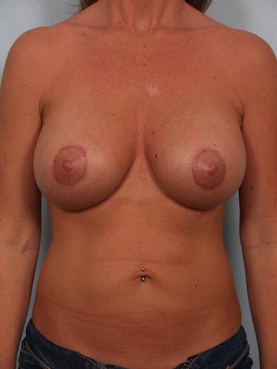 Breast Lift with Implants Before & After Gallery - Patient 1612638 - Image 2