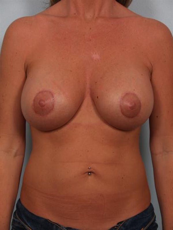 Breast Lift with Implants Before & After Gallery - Patient 1612638 - Image 2