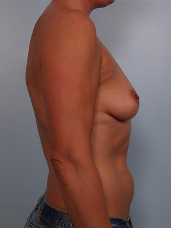 Breast Lift with Implants Before & After Gallery - Patient 1612639 - Image 1