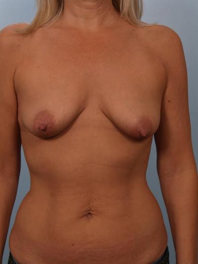 Breast Lift with Implants Before & After Gallery - Patient 1612640 - Image 1