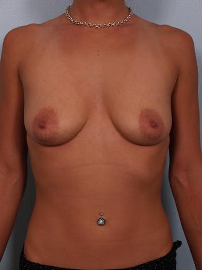 Breast Lift with Implants Before & After Gallery - Patient 1612643 - Image 1