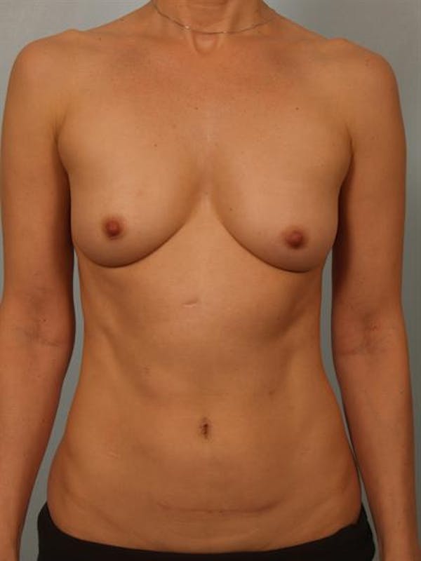 Breast Lift with Implants Before & After Gallery - Patient 1612646 - Image 3