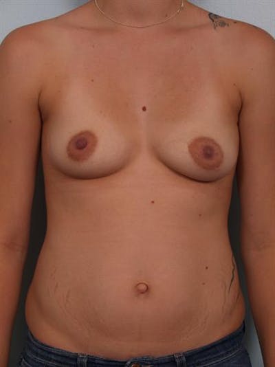 Breast Lift with Implants Gallery - Patient 1612647 - Image 1
