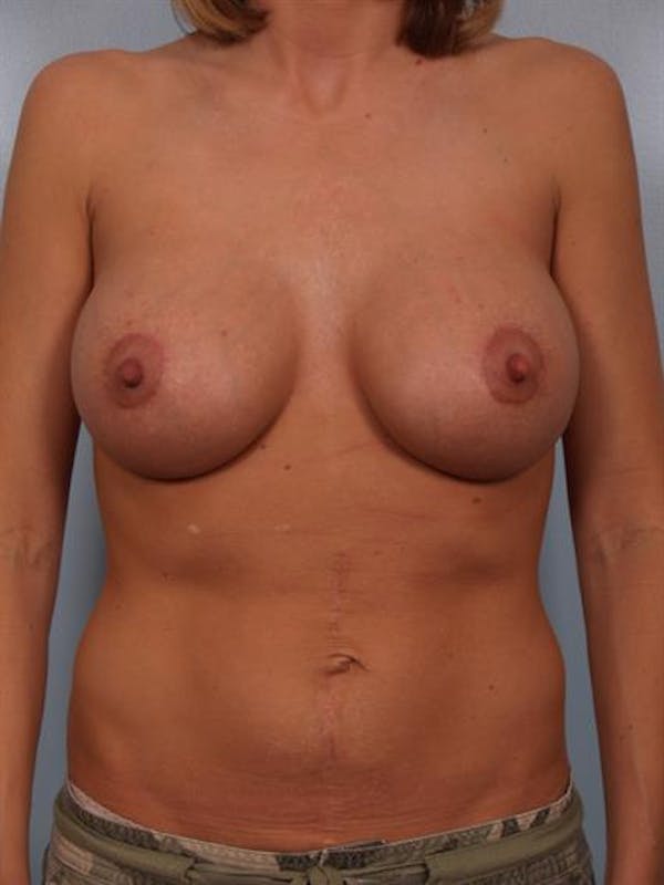 Breast Lift with Implants Before & After Gallery - Patient 1612649 - Image 6