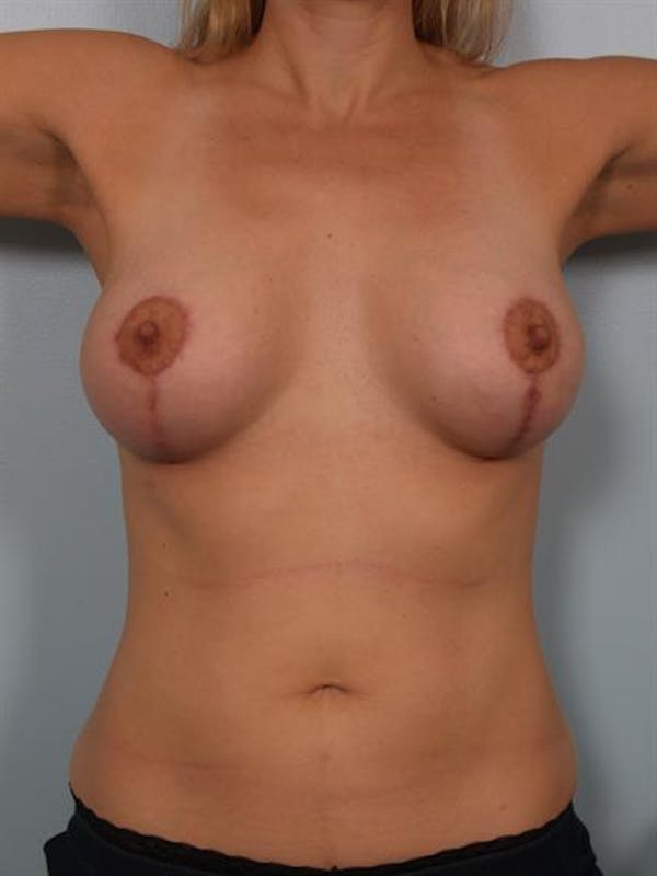 Breast Lift with Implants Gallery - Patient 1612653 - Image 6