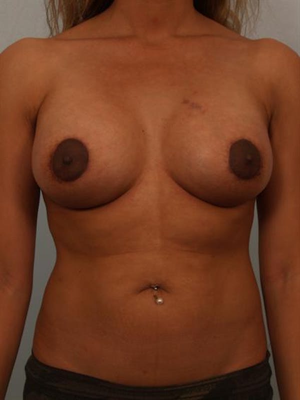Breast Lift with Implants Gallery - Patient 1612656 - Image 2