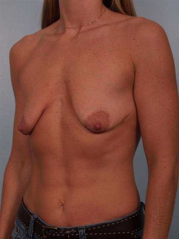 Breast Lift with Implants Gallery - Patient 1612657 - Image 5