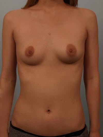Breast Lift with Implants Before & After Gallery - Patient 1612659 - Image 1