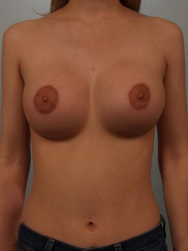 Breast Lift with Implants Before & After Gallery - Patient 1612659 - Image 2