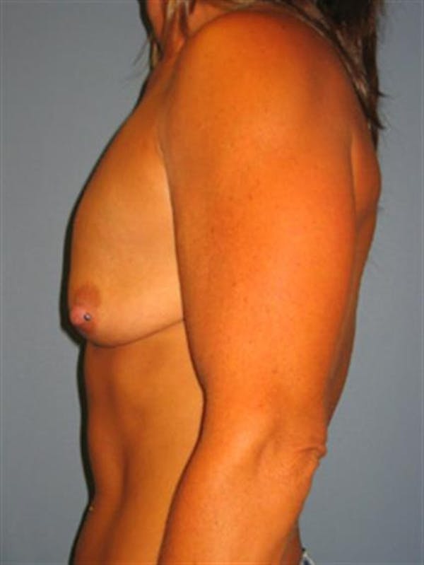 Breast Lift with Implants Before & After Gallery - Patient 1612660 - Image 5