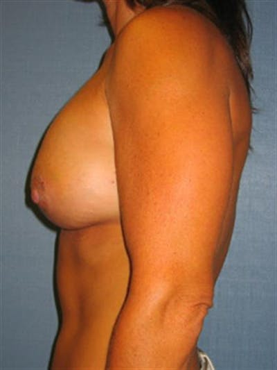 Breast Lift with Implants Before & After Gallery - Patient 1612660 - Image 6