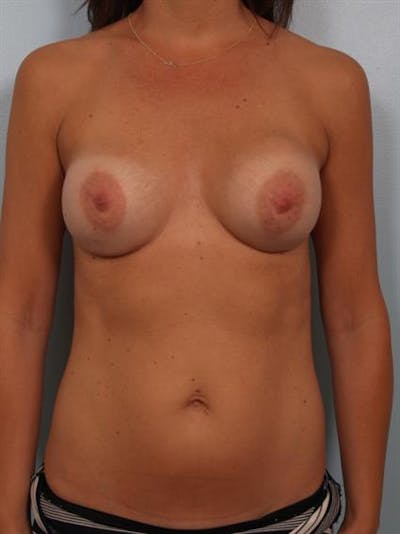 Breast Lift with Implants Before & After Gallery - Patient 1612661 - Image 1
