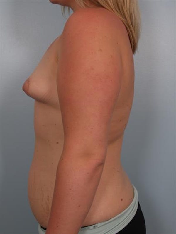 Breast Lift with Implants Before & After Gallery - Patient 1612666 - Image 1