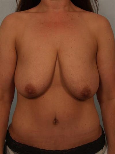 Breast Lift with Implants Before & After Gallery - Patient 1612671 - Image 1