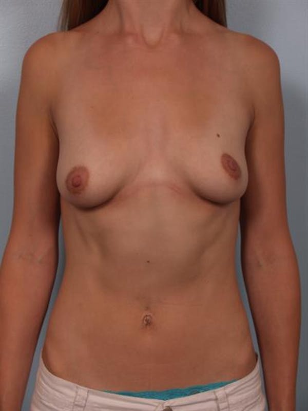 Breast Lift with Implants Before & After Gallery - Patient 1612674 - Image 1