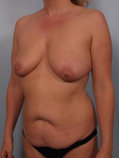 Breast Lift with Implants Gallery - Patient 1612676 - Image 1