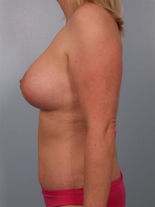 Breast Lift with Implants Gallery - Patient 1612676 - Image 6