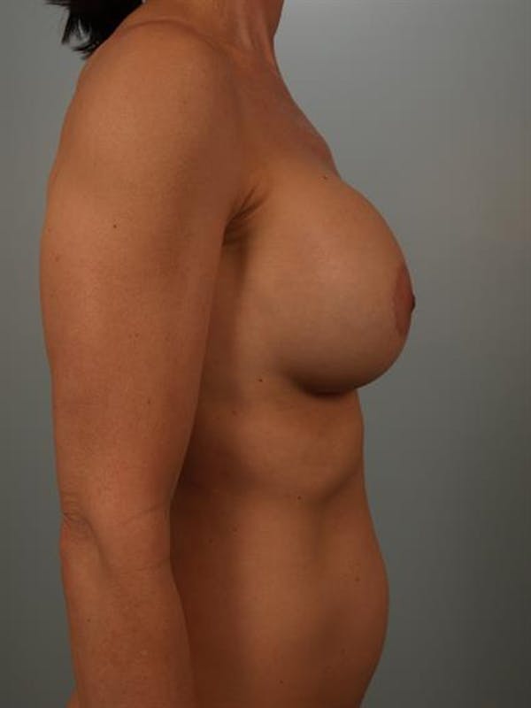 Breast Lift with Implants Before & After Gallery - Patient 1612680 - Image 6