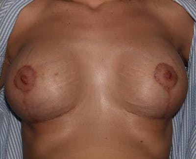 Breast Lift with Implants Before & After Gallery - Patient 1612682 - Image 8