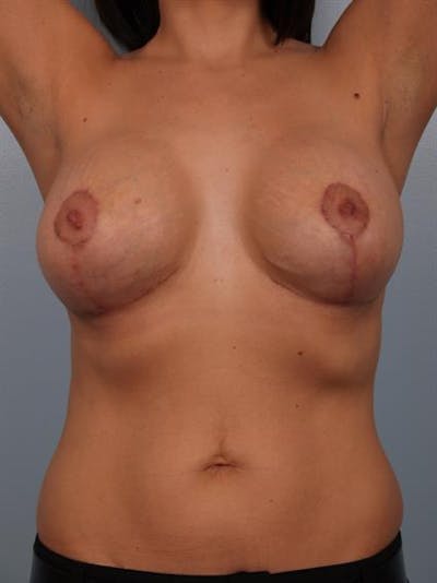Breast Lift with Implants Before & After Gallery - Patient 1612682 - Image 10