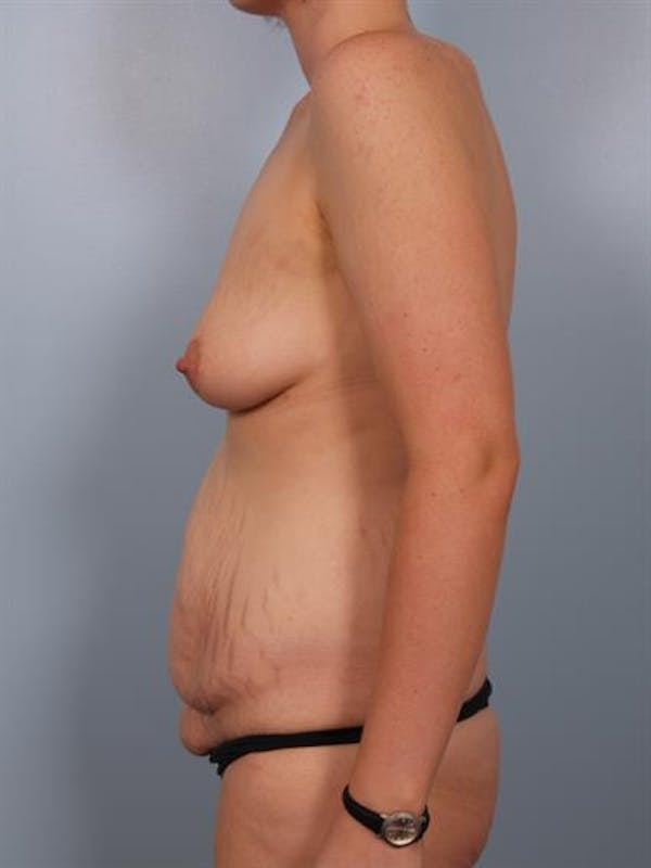 Breast Lift with Implants Before & After Gallery - Patient 1612686 - Image 5