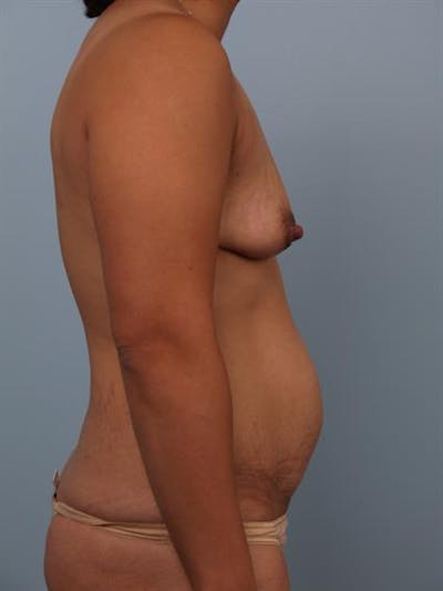Breast Lift with Implants Gallery - Patient 1612688 - Image 1