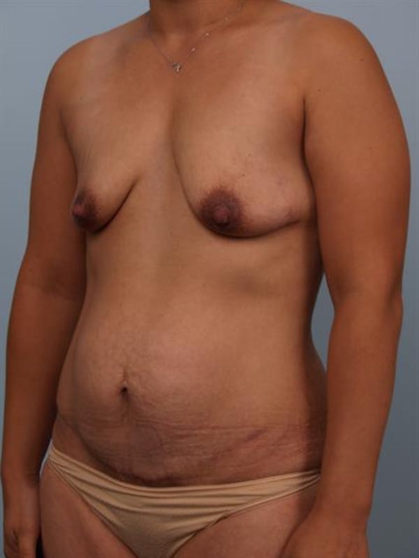 Breast Lift with Implants Before & After Gallery - Patient 1612688 - Image 5