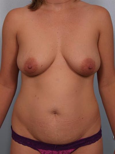 Breast Lift with Implants Before & After Gallery - Patient 1612689 - Image 1