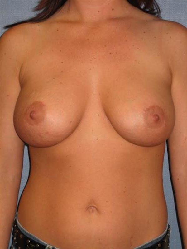 Breast Lift with Implants Before & After Gallery - Patient 1612691 - Image 4