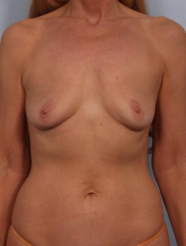 Breast Lift with Implants Before & After Gallery - Patient 1612693 - Image 1